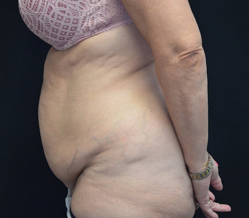 Abdominoplasty (Tummy Tuck) Before & After Gallery - Patient 114720989 - Image 9
