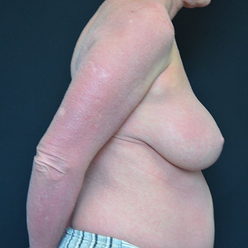 Breast Lift Before & After Gallery - Patient 114720990 - Image 7