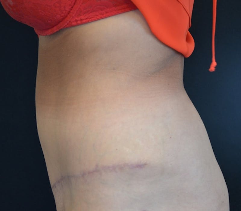 Abdominoplasty (Tummy Tuck) Before & After Gallery - Patient 114720989 - Image 10