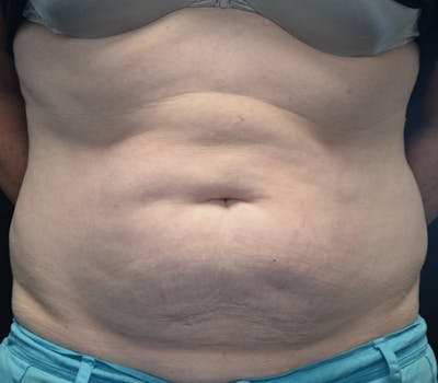 Abdominoplasty (Tummy Tuck) Before & After Gallery - Patient 114720994 - Image 1