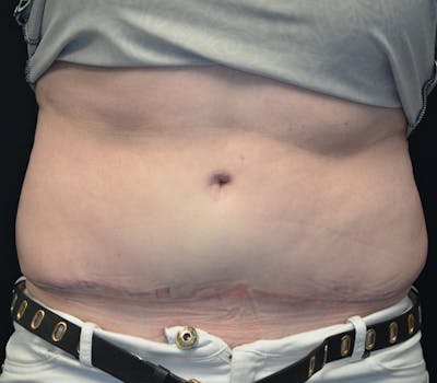 Abdominoplasty (Tummy Tuck) Before & After Gallery - Patient 114720994 - Image 2