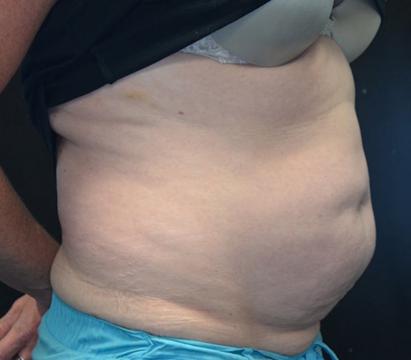 Abdominoplasty (Tummy Tuck) Before & After Gallery - Patient 114720994 - Image 3