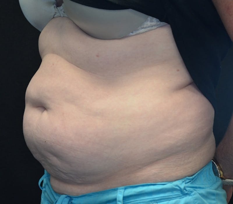 Abdominoplasty (Tummy Tuck) Before & After Gallery - Patient 114720994 - Image 5