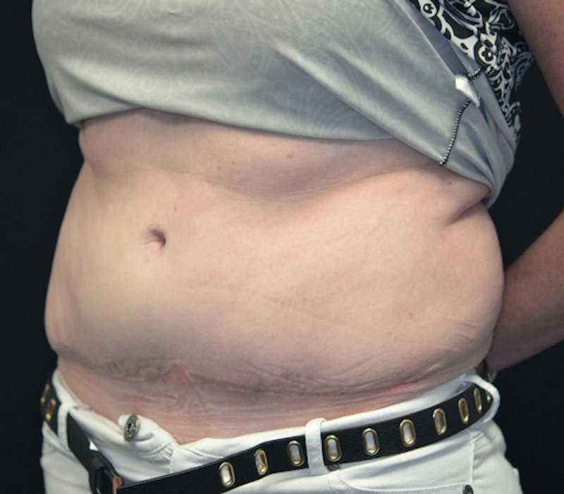 Abdominoplasty (Tummy Tuck) Before & After Gallery - Patient 114720994 - Image 6