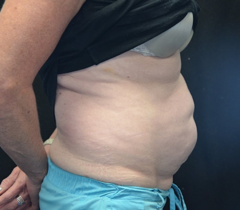 Abdominoplasty (Tummy Tuck) Before & After Gallery - Patient 114720994 - Image 7