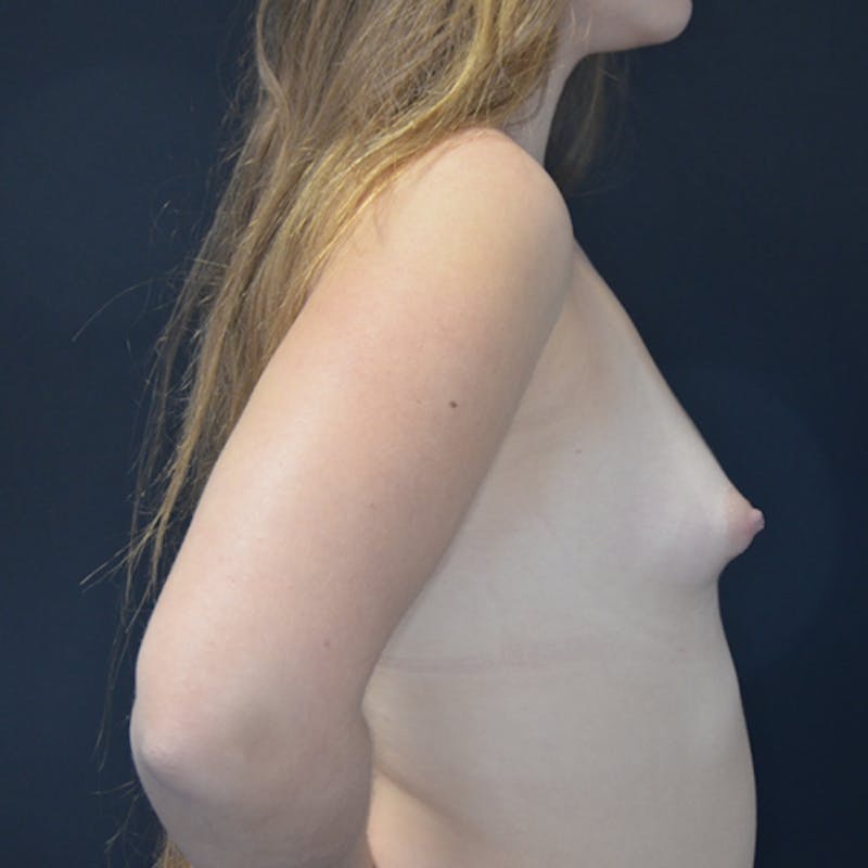 Breast Augmentation Before & After Gallery - Patient 114720995 - Image 7