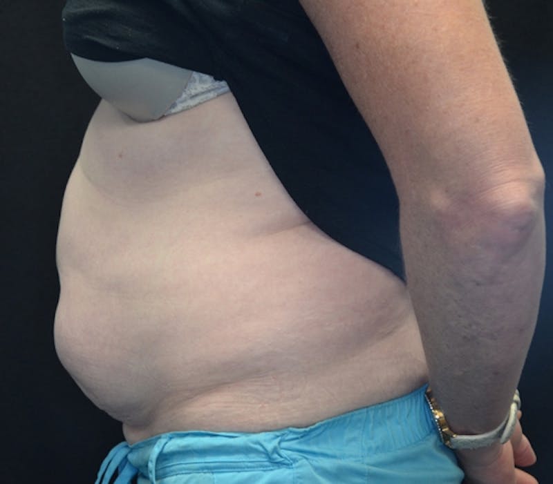 Abdominoplasty (Tummy Tuck) Before & After Gallery - Patient 114720994 - Image 9