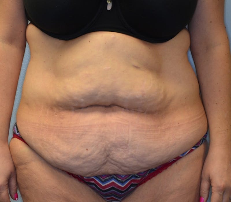 Abdominoplasty (Tummy Tuck) Before & After Gallery - Patient 114721019 - Image 1
