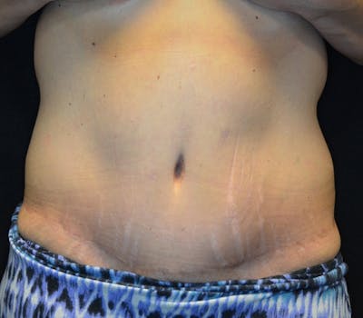 Abdominoplasty (Tummy Tuck) Before & After Gallery - Patient 114721019 - Image 2