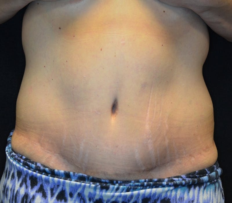 Abdominoplasty (Tummy Tuck) Before & After Gallery - Patient 114721019 - Image 2