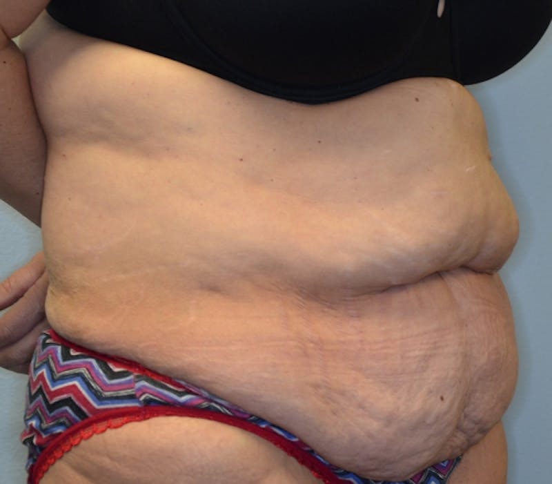 Abdominoplasty (Tummy Tuck) Before & After Gallery - Patient 114721019 - Image 3