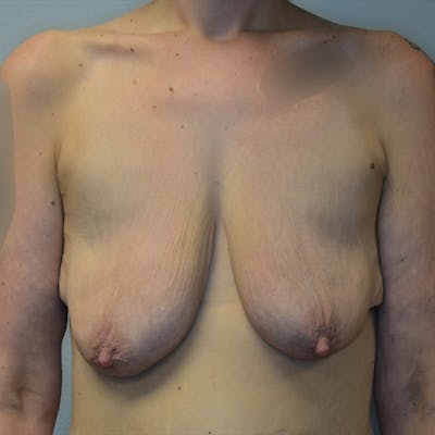 Breast Lift Before & After Gallery - Patient 114721021 - Image 1