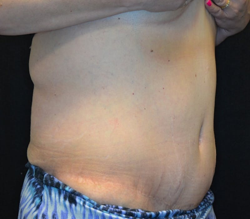 Abdominoplasty (Tummy Tuck) Before & After Gallery - Patient 114721019 - Image 4