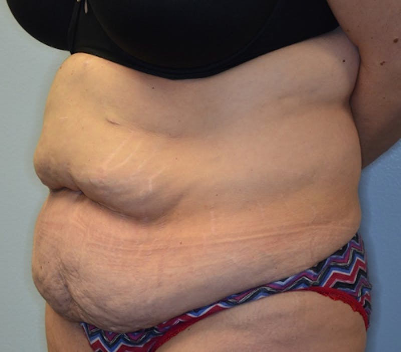 Abdominoplasty (Tummy Tuck) Before & After Gallery - Patient 114721019 - Image 5