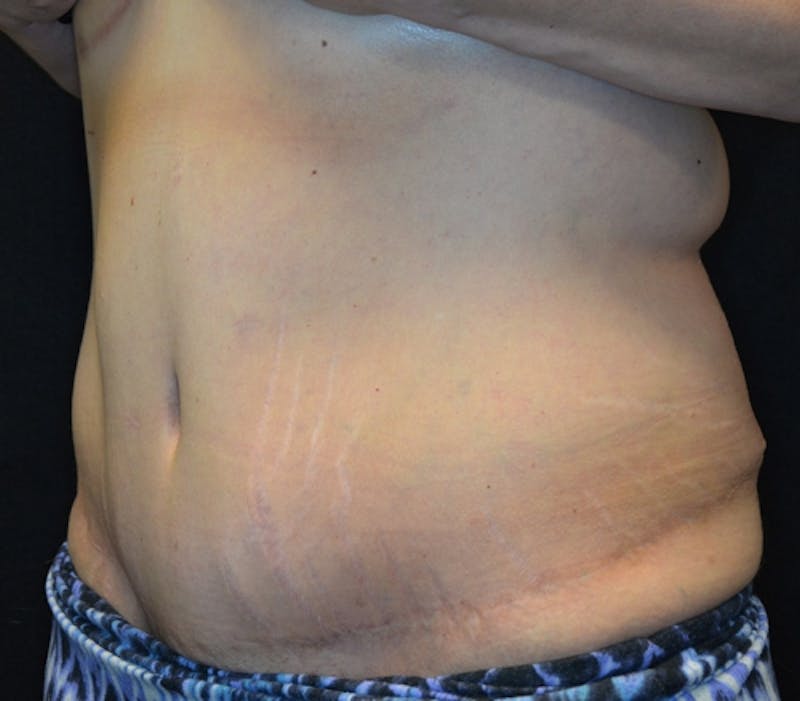 Abdominoplasty (Tummy Tuck) Before & After Gallery - Patient 114721019 - Image 6