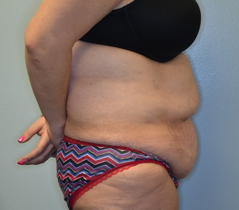 Abdominoplasty (Tummy Tuck) Before & After Gallery - Patient 114721019 - Image 7