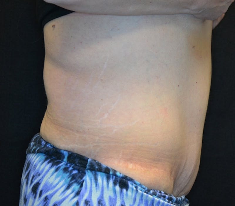 Abdominoplasty (Tummy Tuck) Before & After Gallery - Patient 114721019 - Image 8