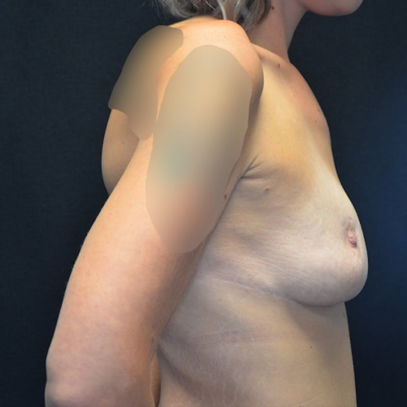 Breast Lift Before & After Gallery - Patient 114721021 - Image 6