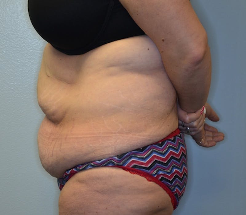 Abdominoplasty (Tummy Tuck) Before & After Gallery - Patient 114721019 - Image 9