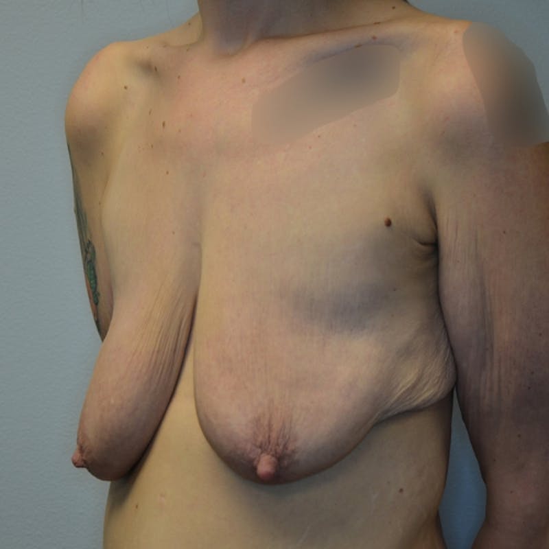 Breast Lift Before & After Gallery - Patient 114721021 - Image 7