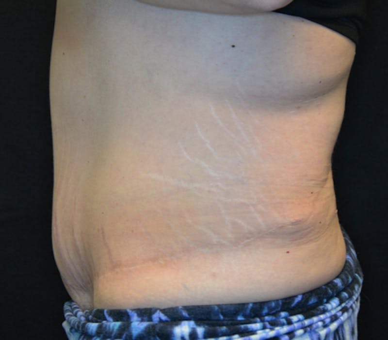 Abdominoplasty (Tummy Tuck) Before & After Gallery - Patient 114721019 - Image 10