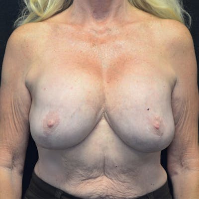 Breast Augmentation with Lift Before & After Gallery - Patient 114721024 - Image 1