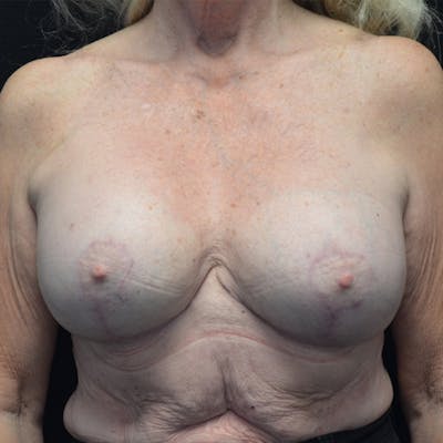 Breast Augmentation with Lift Before & After Gallery - Patient 114721024 - Image 2