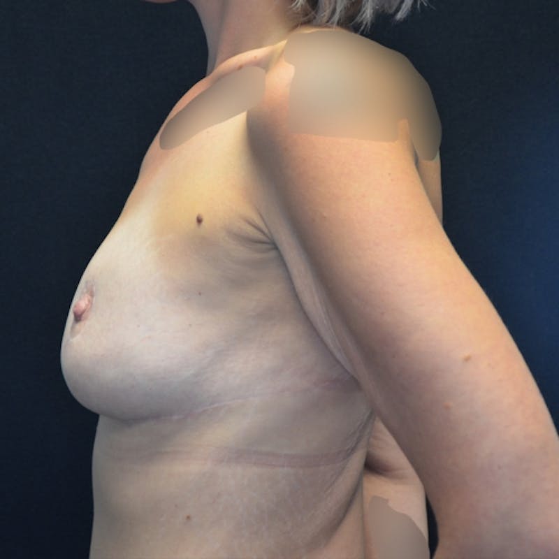 Breast Lift Before & After Gallery - Patient 114721021 - Image 10