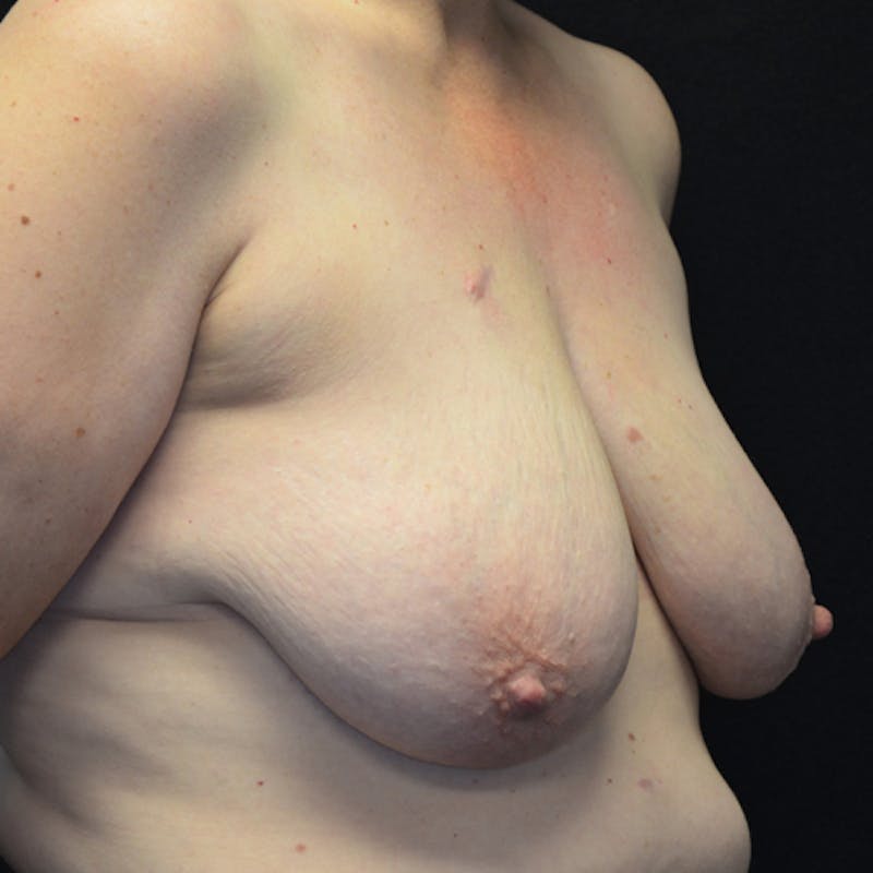 Breast Lift Before & After Gallery - Patient 114721026 - Image 3