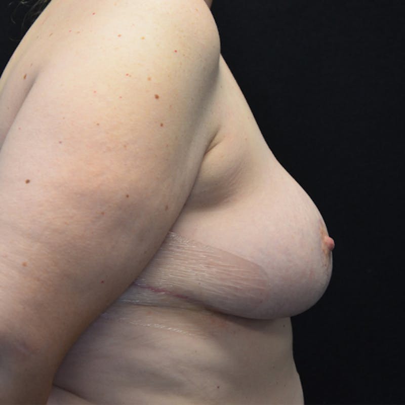 Breast Lift Before & After Gallery - Patient 114721026 - Image 6