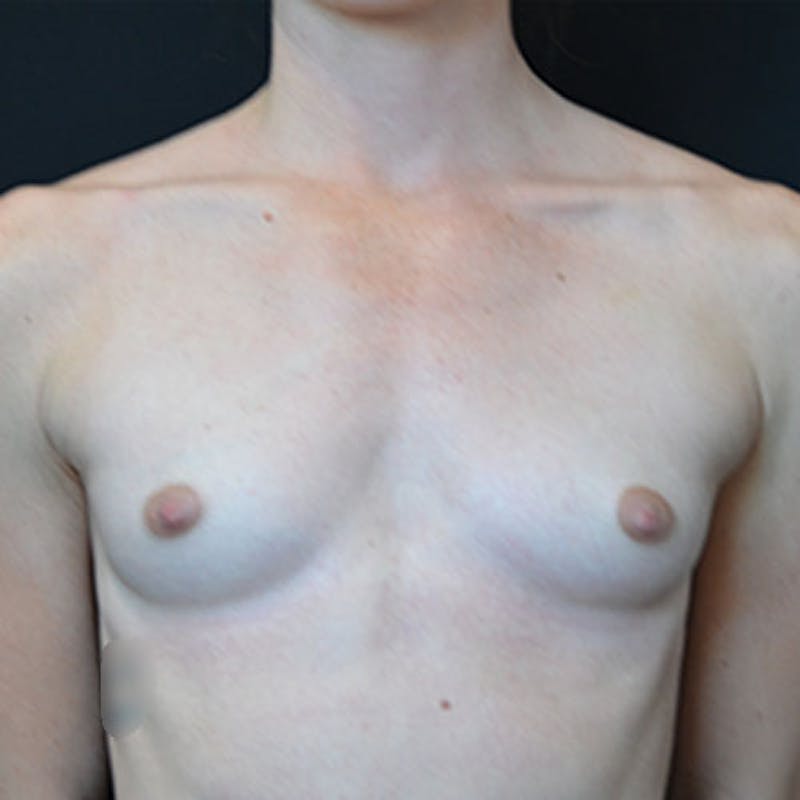 Breast Augmentation Before & After Gallery - Patient 114721028 - Image 1
