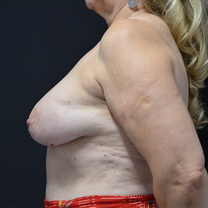 Breast Reconstruction Before & After Gallery - Patient 114721023 - Image 10