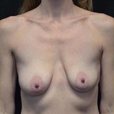 Breast Augmentation with Lift Before & After Gallery - Patient 114721031 - Image 1