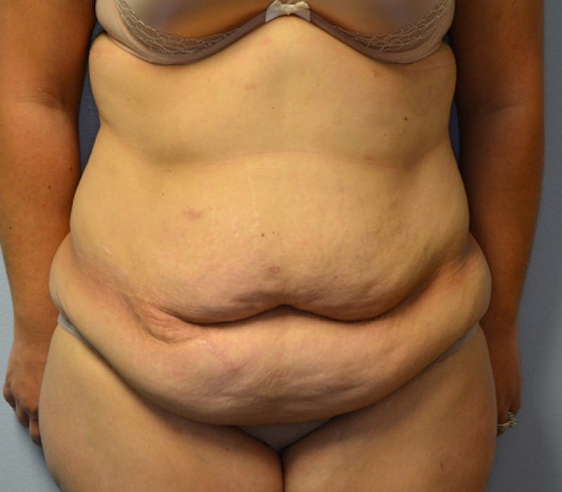 Abdominoplasty (Tummy Tuck) Before & After Gallery - Patient 114721030 - Image 1
