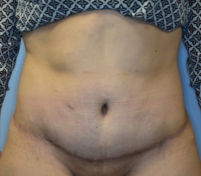 Abdominoplasty (Tummy Tuck) Before & After Gallery - Patient 114721030 - Image 2