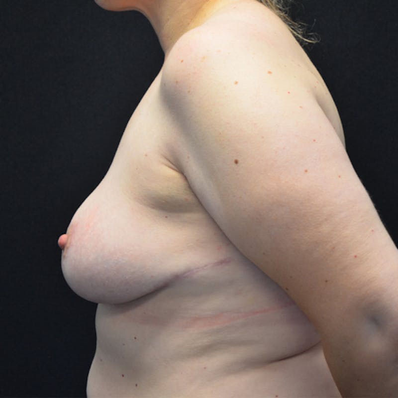 Breast Lift Before & After Gallery - Patient 114721026 - Image 10