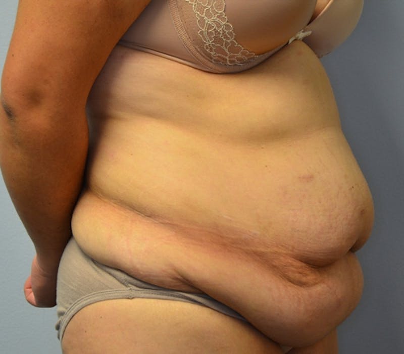 Abdominoplasty (Tummy Tuck) Before & After Gallery - Patient 114721030 - Image 3