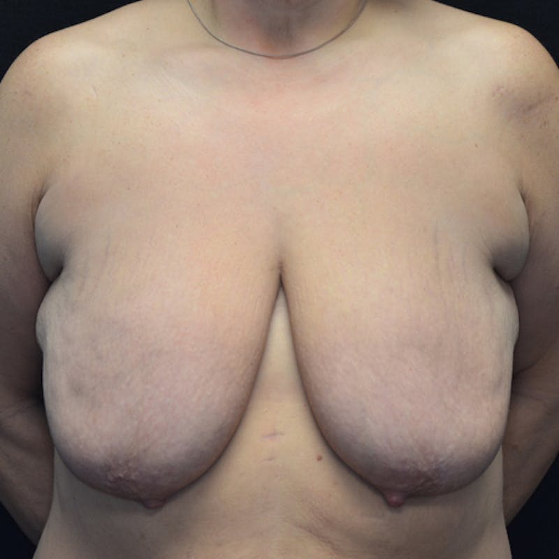 Breast Lift Before & After Gallery - Patient 114721032 - Image 1