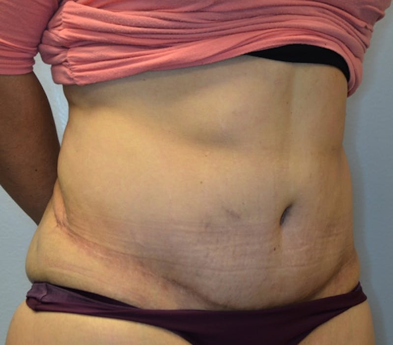 Abdominoplasty (Tummy Tuck) Before & After Gallery - Patient 114721030 - Image 4