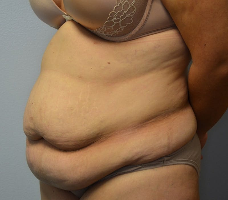 Abdominoplasty (Tummy Tuck) Before & After Gallery - Patient 114721030 - Image 5
