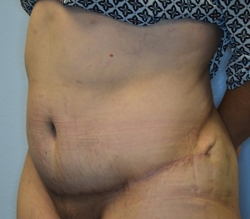 Abdominoplasty (Tummy Tuck) Before & After Gallery - Patient 114721030 - Image 6