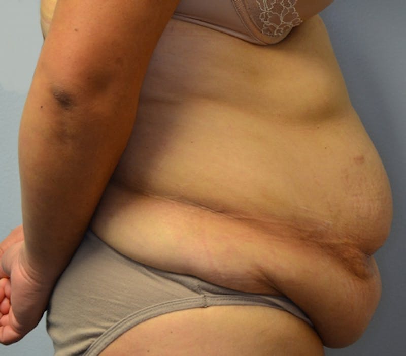 Abdominoplasty (Tummy Tuck) Before & After Gallery - Patient 114721030 - Image 7