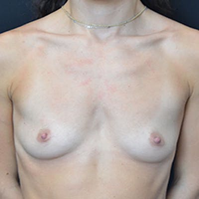 Breast Augmentation Before & After Gallery - Patient 114721034 - Image 1