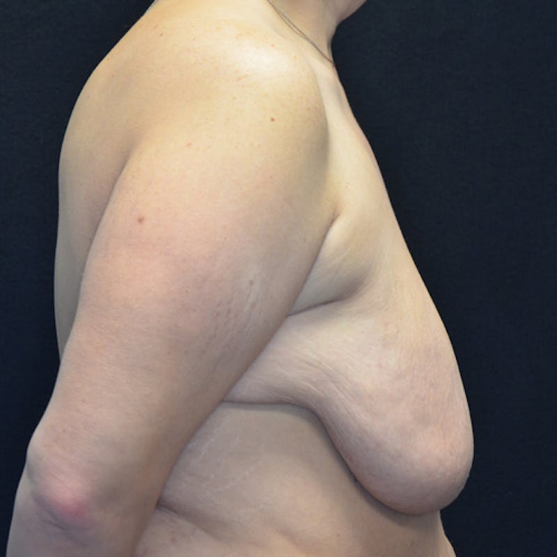 Breast Lift Before & After Gallery - Patient 114721032 - Image 5