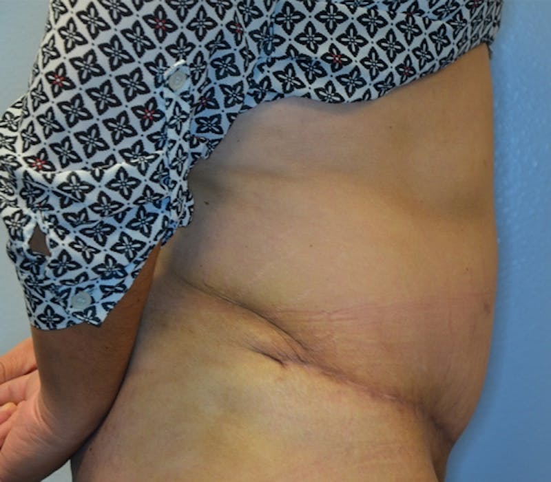 Abdominoplasty (Tummy Tuck) Before & After Gallery - Patient 114721030 - Image 8
