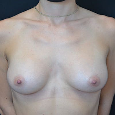 Breast Augmentation Before & After Gallery - Patient 114721034 - Image 2