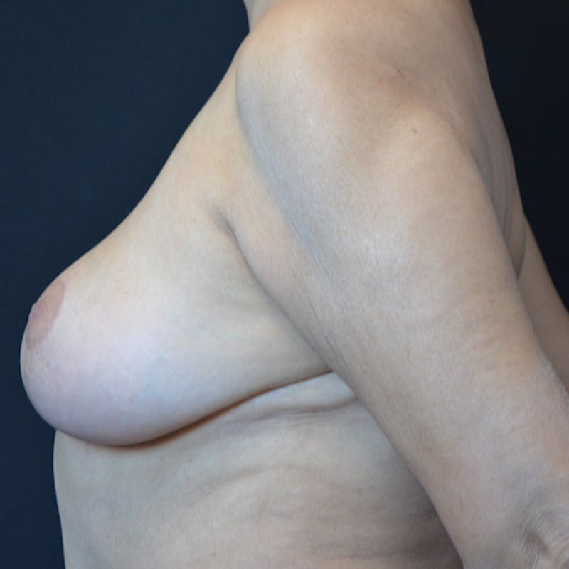 Breast Reduction Before & After Gallery - Patient 114721035 - Image 4