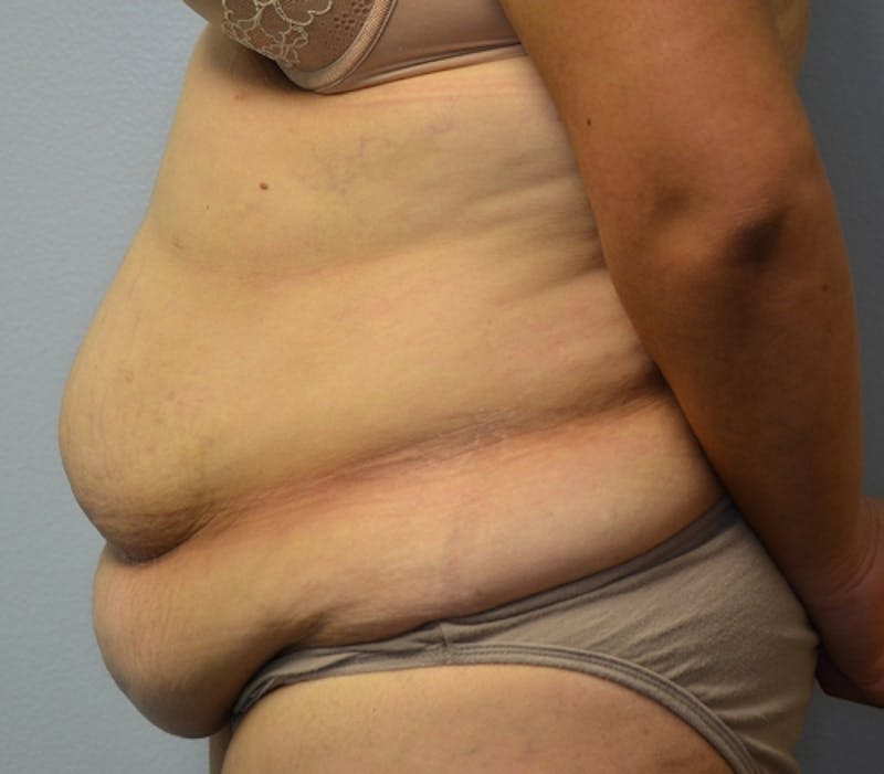 Abdominoplasty (Tummy Tuck) Before & After Gallery - Patient 114721030 - Image 9