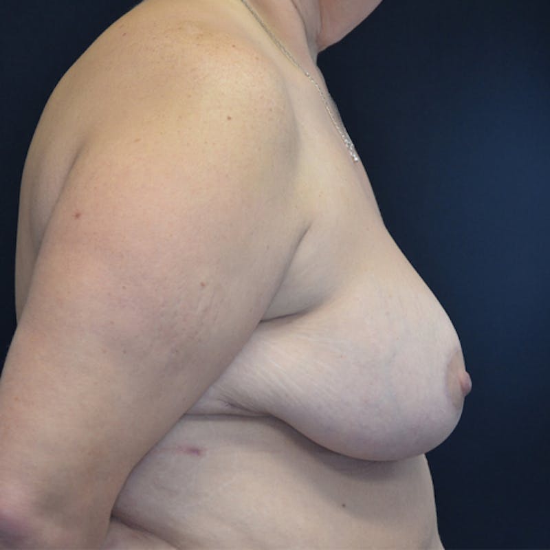Breast Lift Before & After Gallery - Patient 114721032 - Image 6