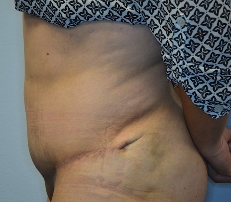 Abdominoplasty (Tummy Tuck) Before & After Gallery - Patient 114721030 - Image 10